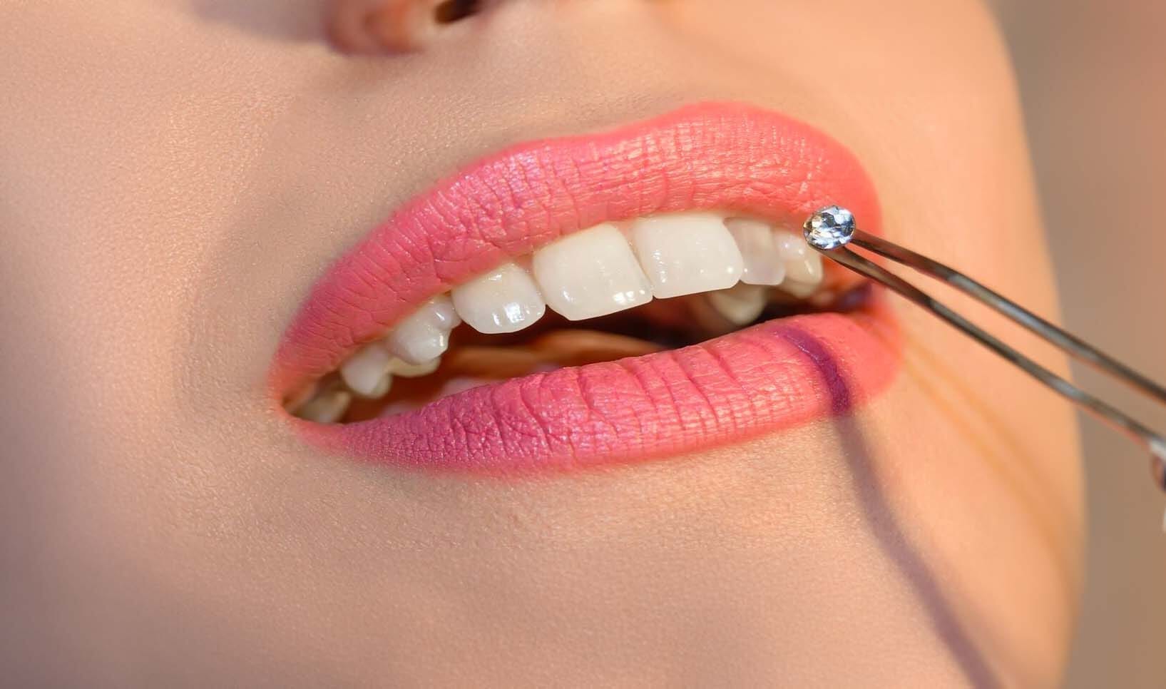 Comment Poser Facilement des Bijoux Dentaires ?