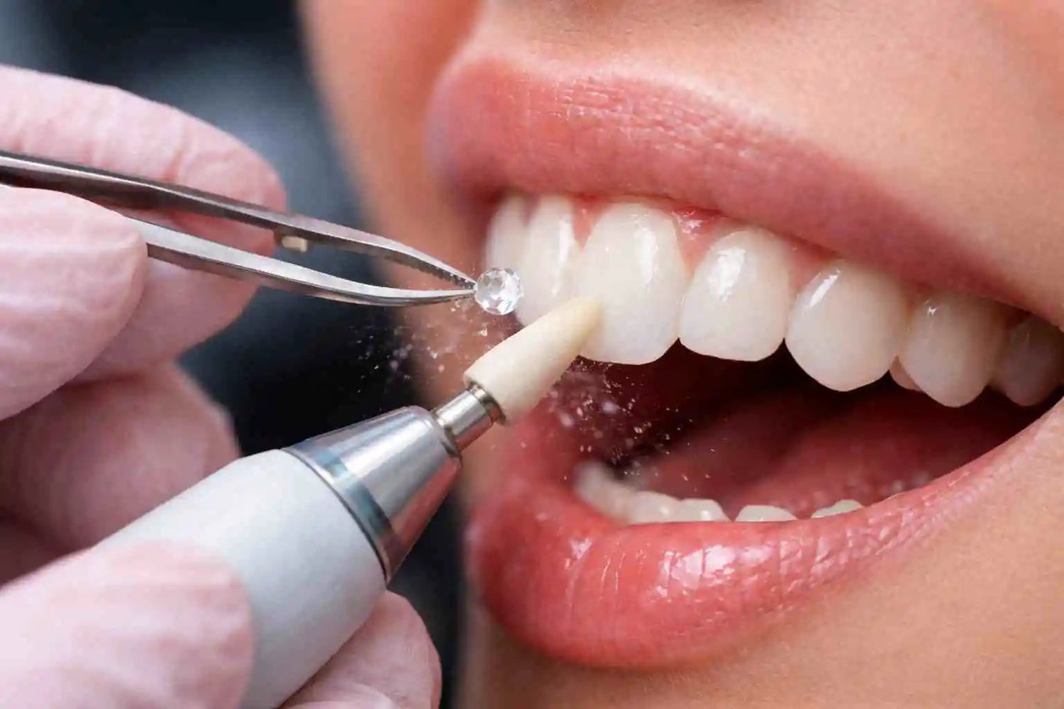 Retirer un bijou dentaire sans abîmer l’émail : ce qu’il faut savoir