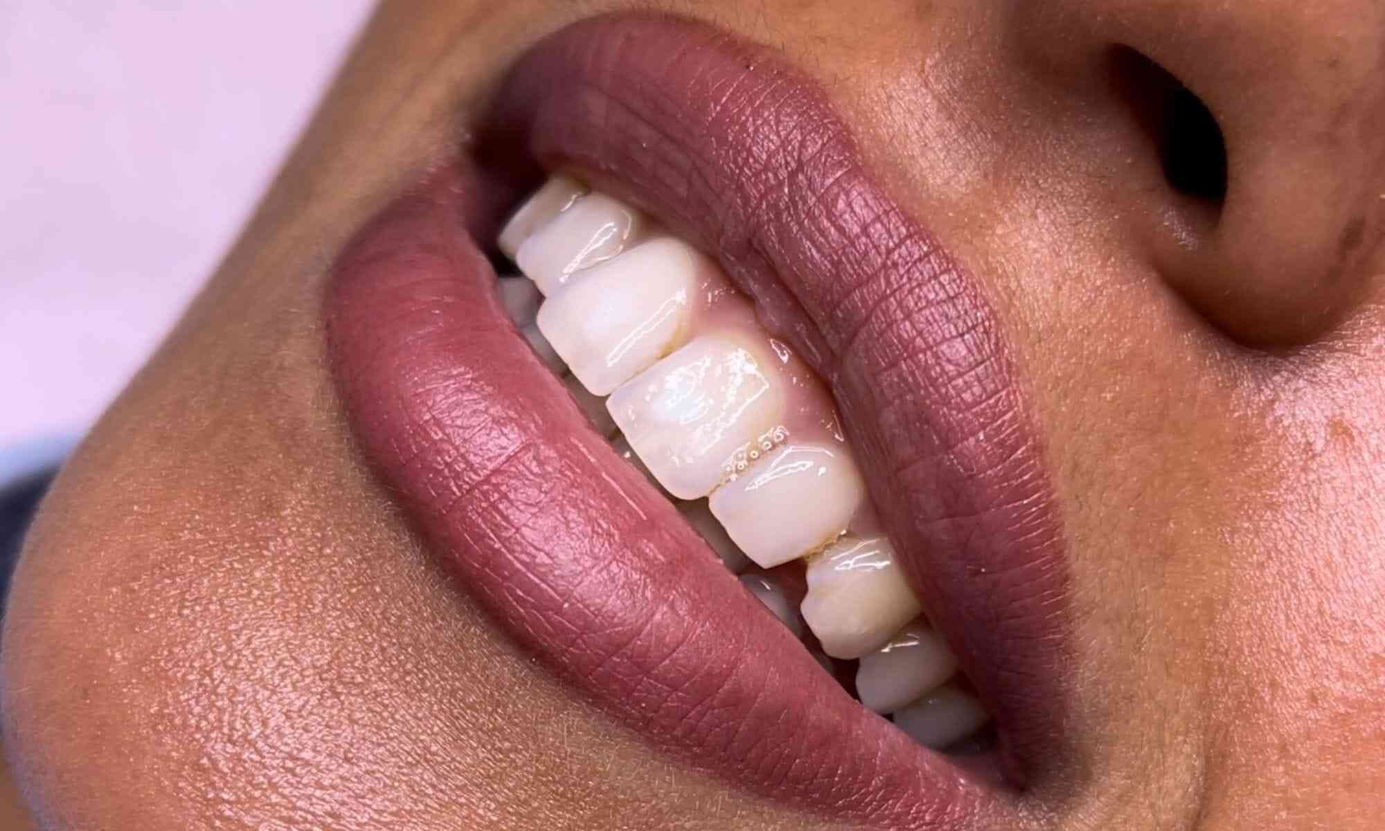 Dentition sans strass dentaire