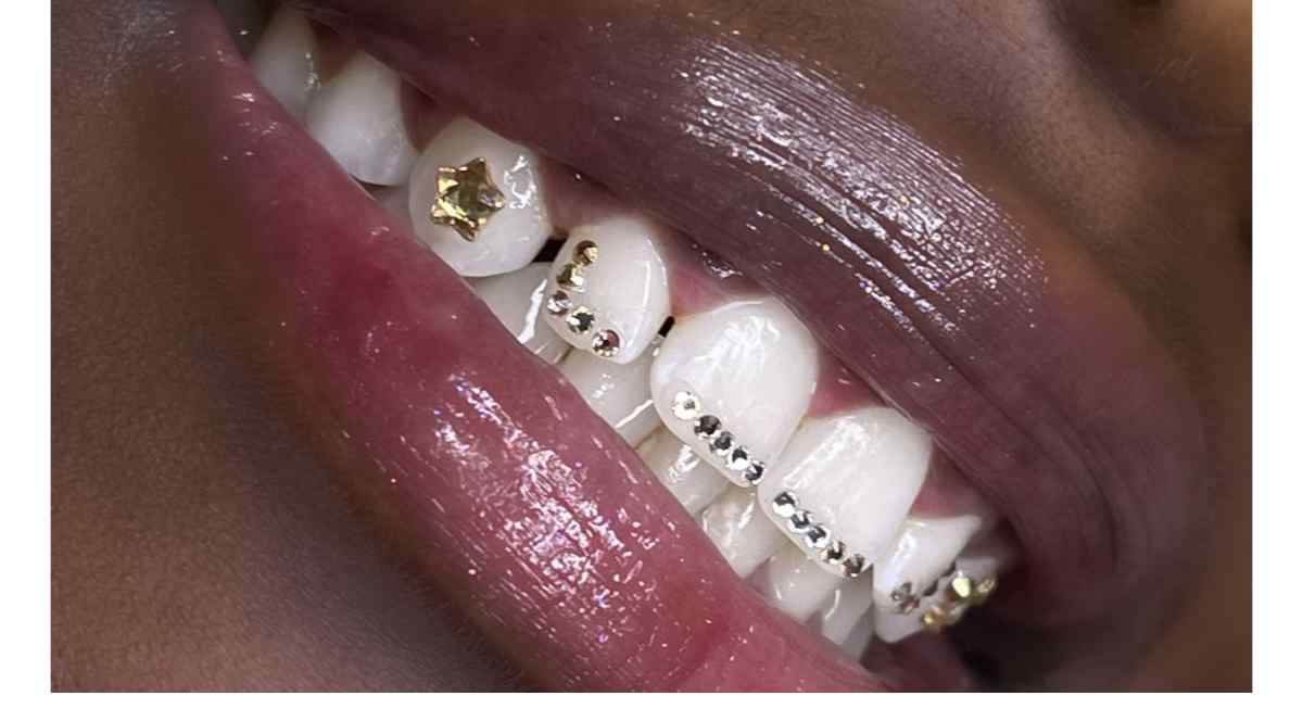 Belle pose de strass dentaire | Tooth Gems World