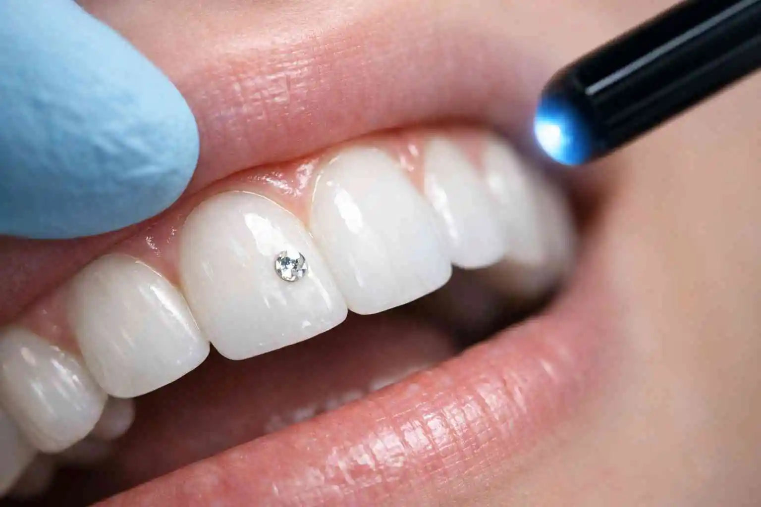 Strass dentaire : Quelle colle pour les dents ? Bien choisir sans abîmer l’émail